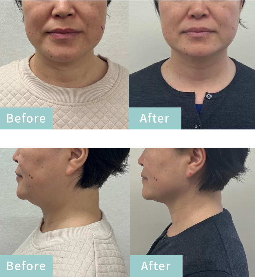 before&After画像